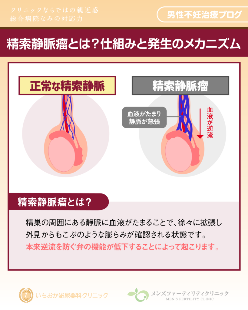 精索静脈瘤とは?仕組みと発生のメカニズム