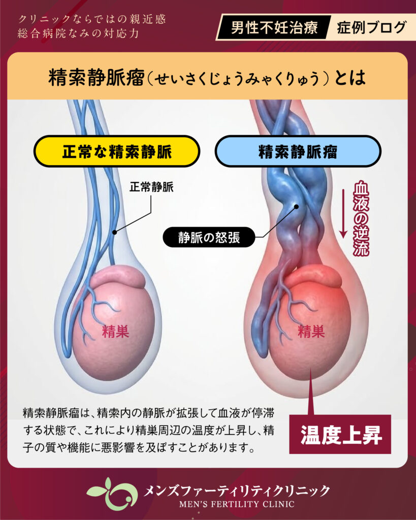 精索静脈瘤とは